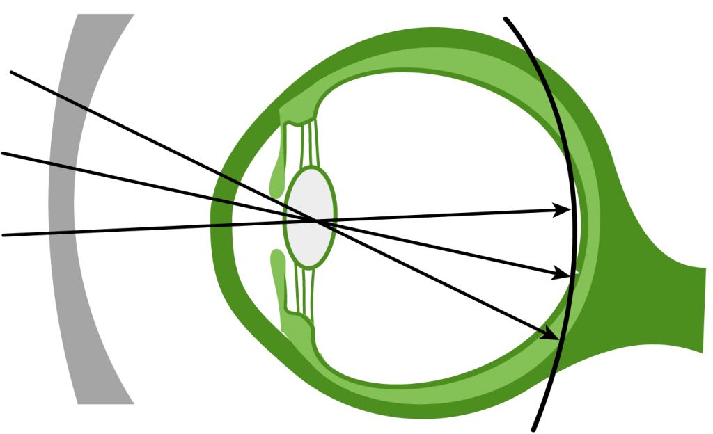 myopia_1