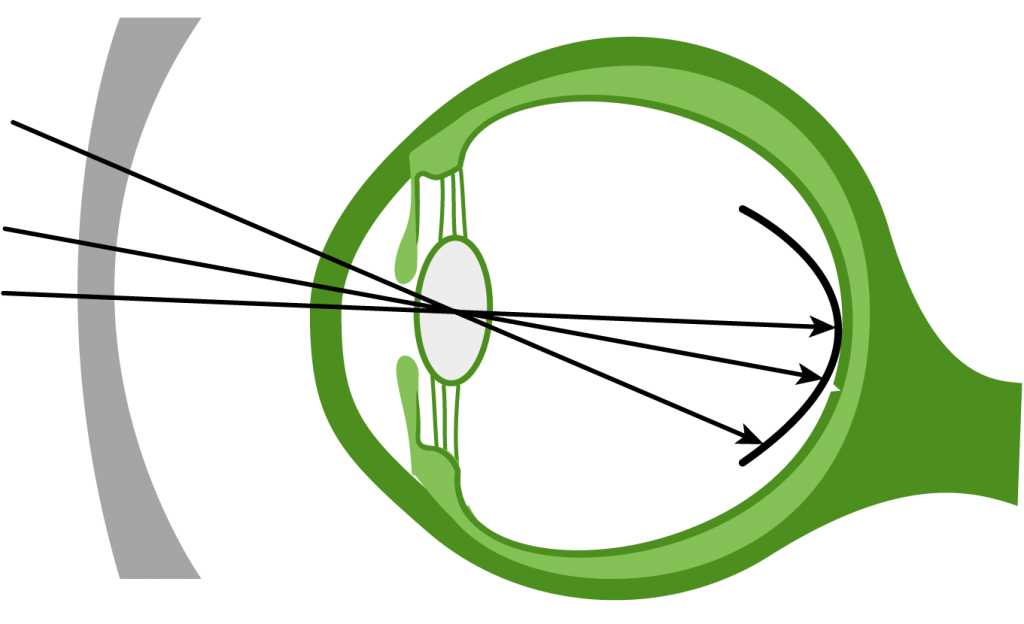 myopia_2